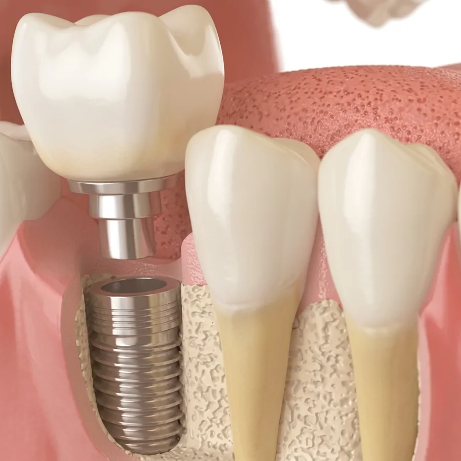 Ilustração do tratamento: Implantes Dentários e Carga Imediata