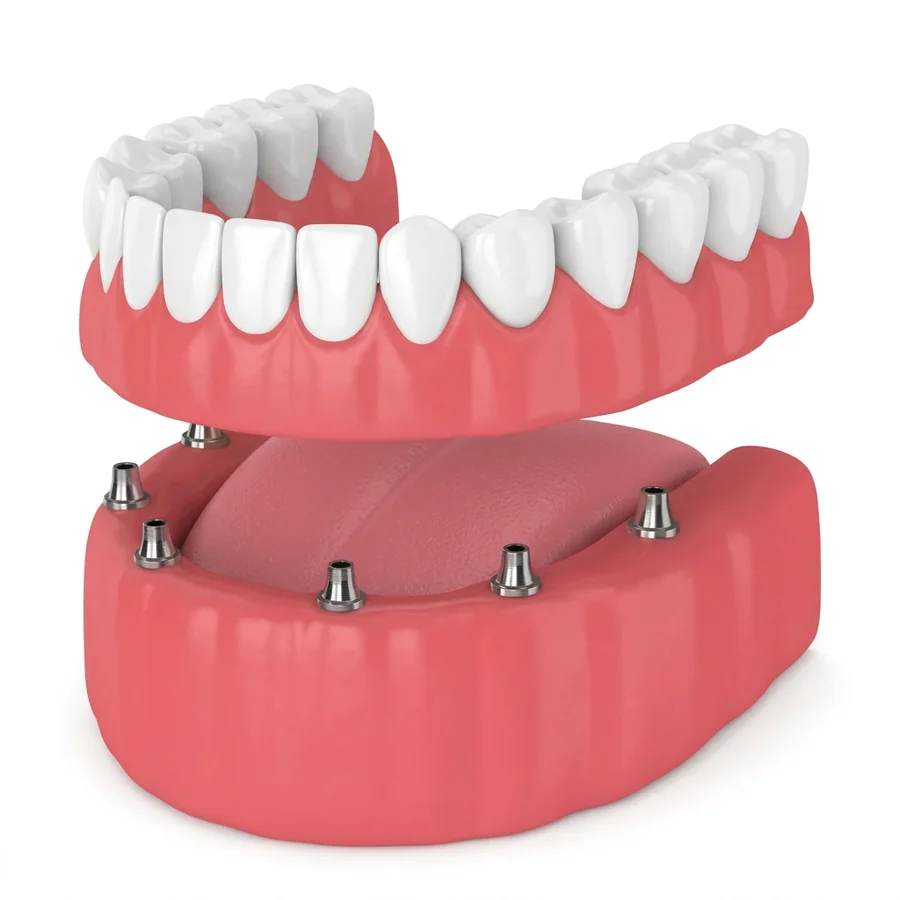 Ilustração do tratamento: Prótese Dentária