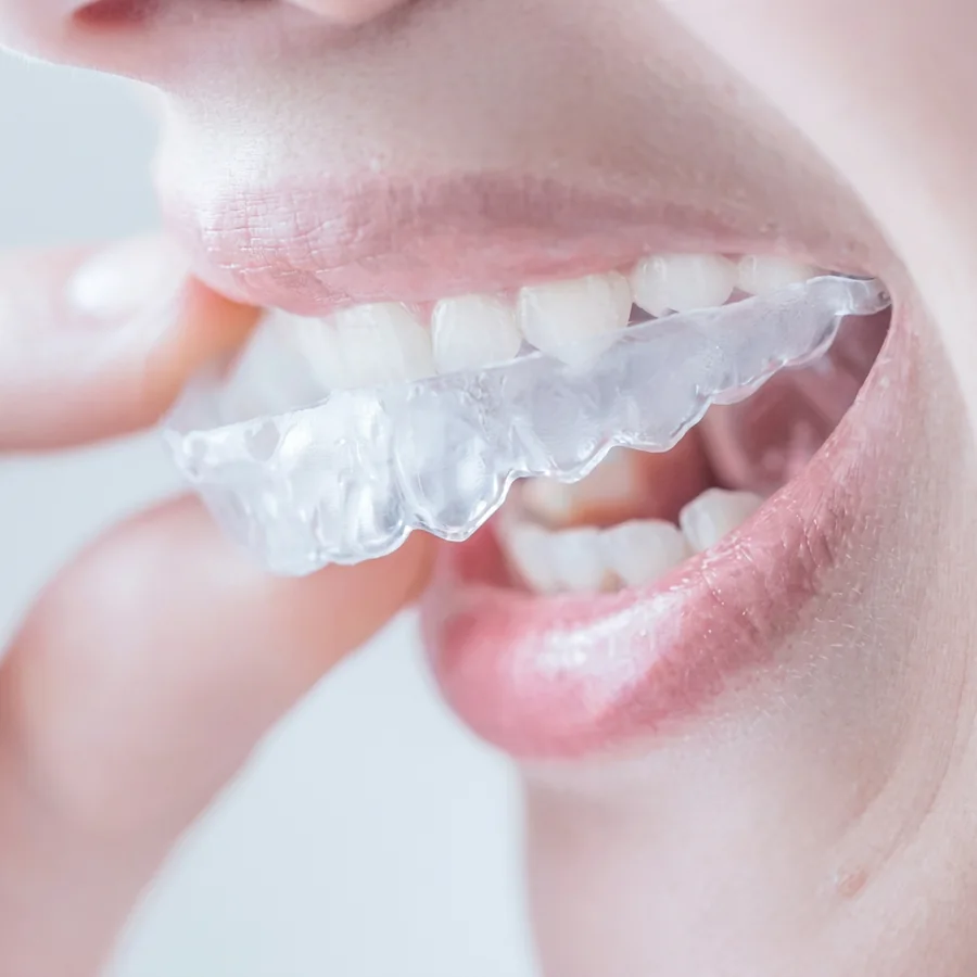 Ilustração do tratamento: Alinhadores Invisíveis e Ortodontia Estética
